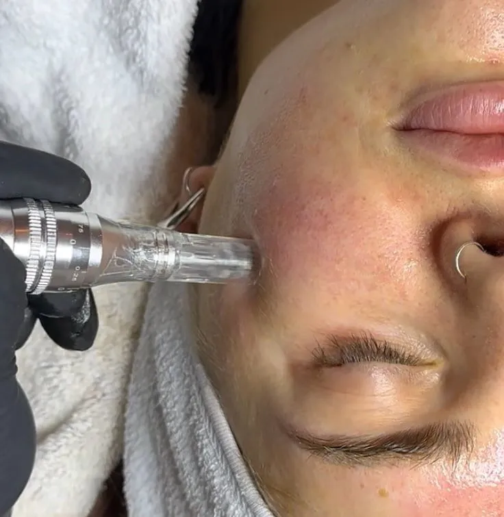 Microneedling ? eine minimalinvasive kosmetische Behandlung zur Hautverjngung, Frderung der Kollagenproduktion und Verbesserung der Hautstruktur. Durch feine Nadeln werden Falten reduziert, Narben gemindert und die Poren verfeinert, fr eine strahlende, elastische Haut mit optimaler Serumaufnahme.