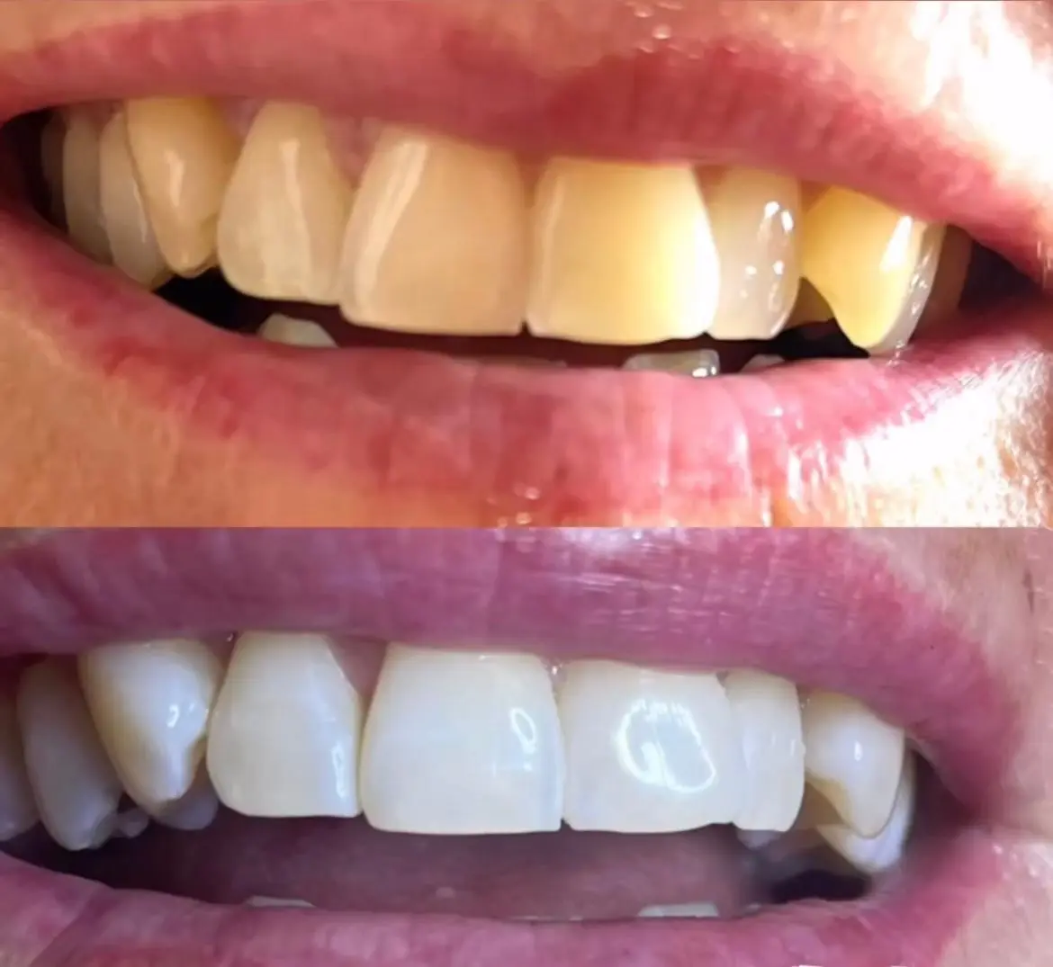 Professionelle Zahnaufhellung fr ein strahlendes Lcheln, durch sichere Bleaching-Methoden zur Reduzierung von Verfrbungen und Verbesserung der Zahnsthetik, individuell angepasst fr optimale Ergebnisse.